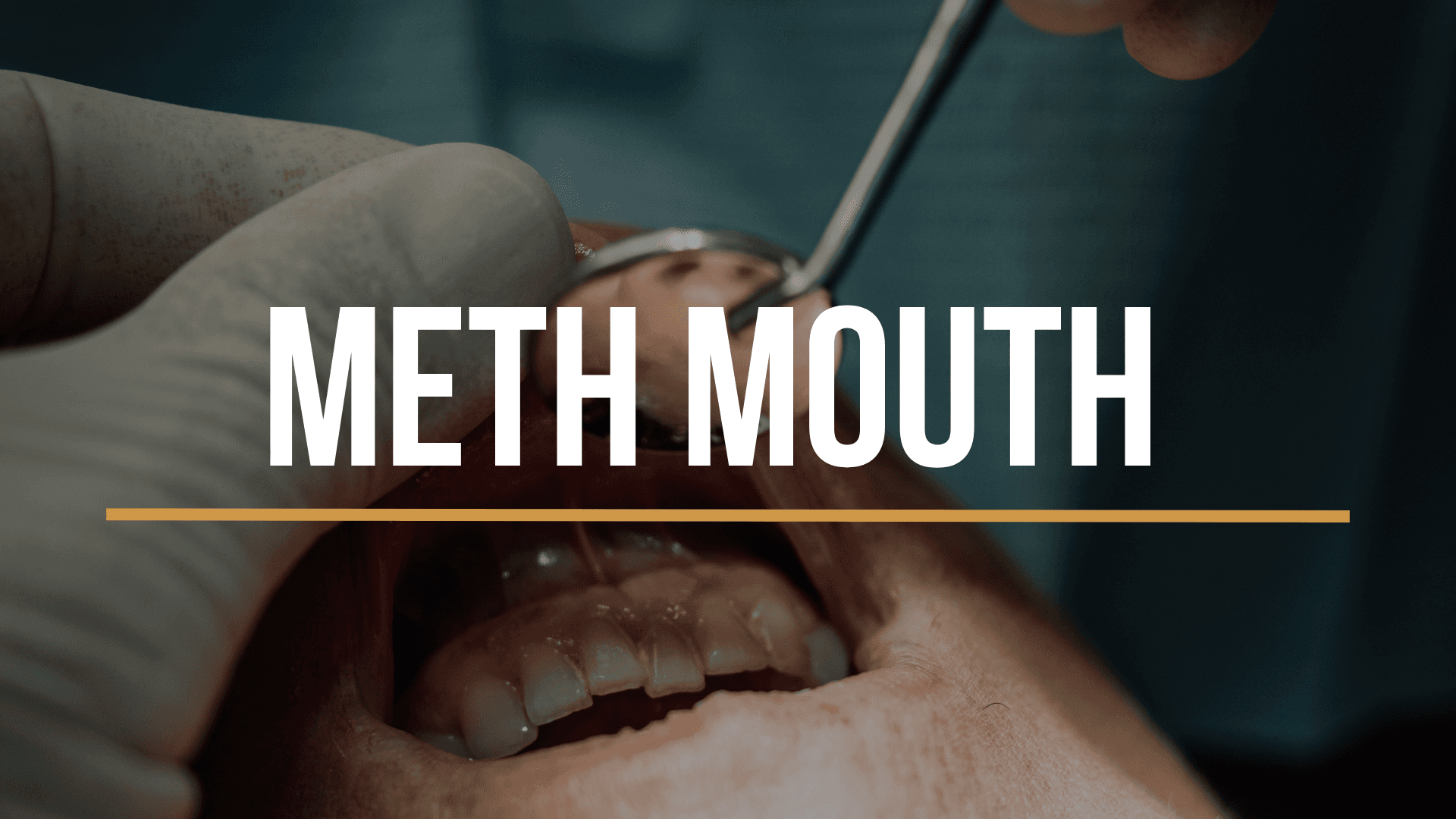 meth-mouth